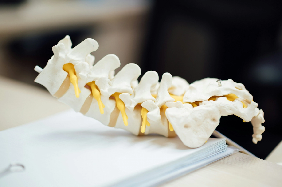A detailed anatomical model of a human lumbar spine, showing off-white vertebrae and yellow intervertebral discs, resting on white papers.