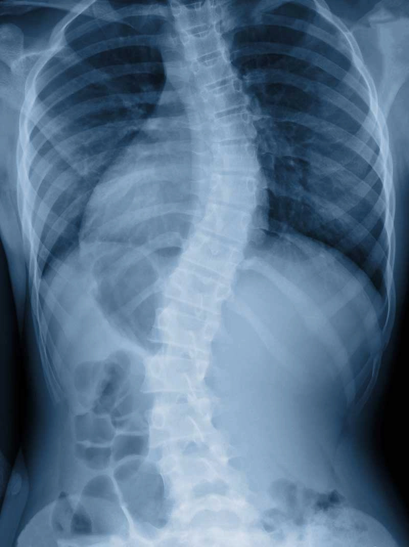 X-ray image of a human torso showing an S-shaped curvature of the spine, indicating scoliosis.